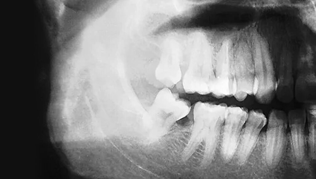 Periodontal Disease and Osteoporosis Vista Dental Clinic
