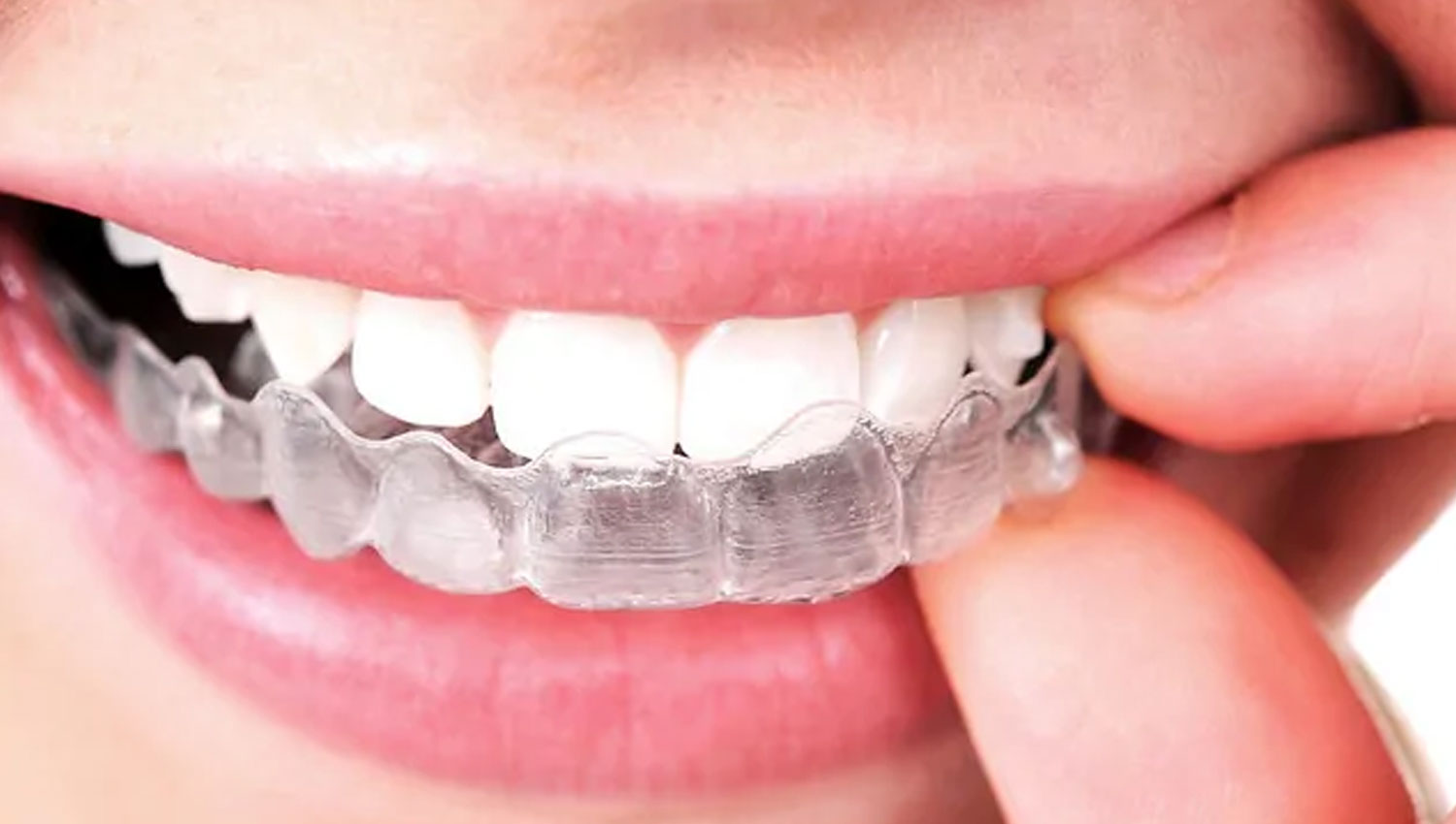 Average Cost of Invisalign Invisalign Toronto Vista Dental Clinic