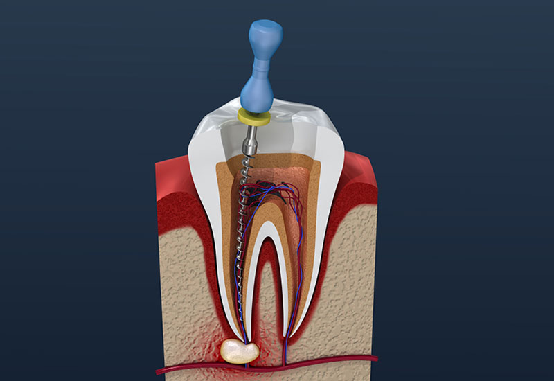 endodontics in scarborough