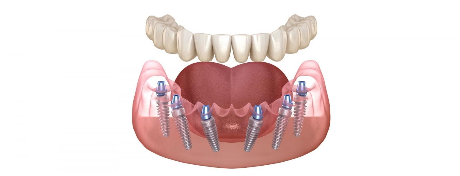 What Is Best Dentures Implants