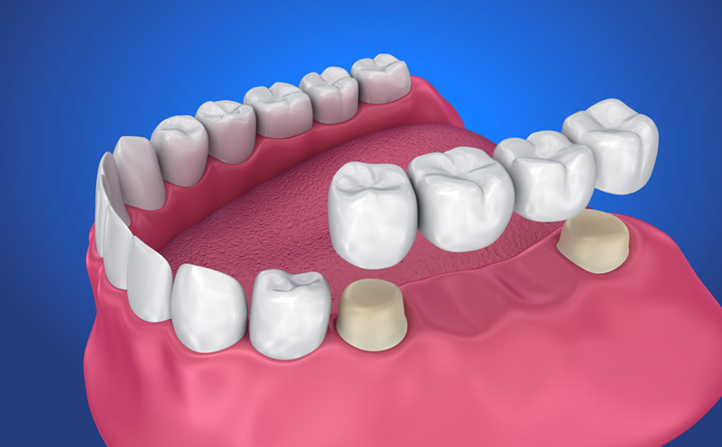 dental bridges in scarborough