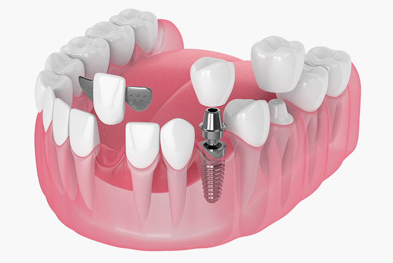 dental bridges near you