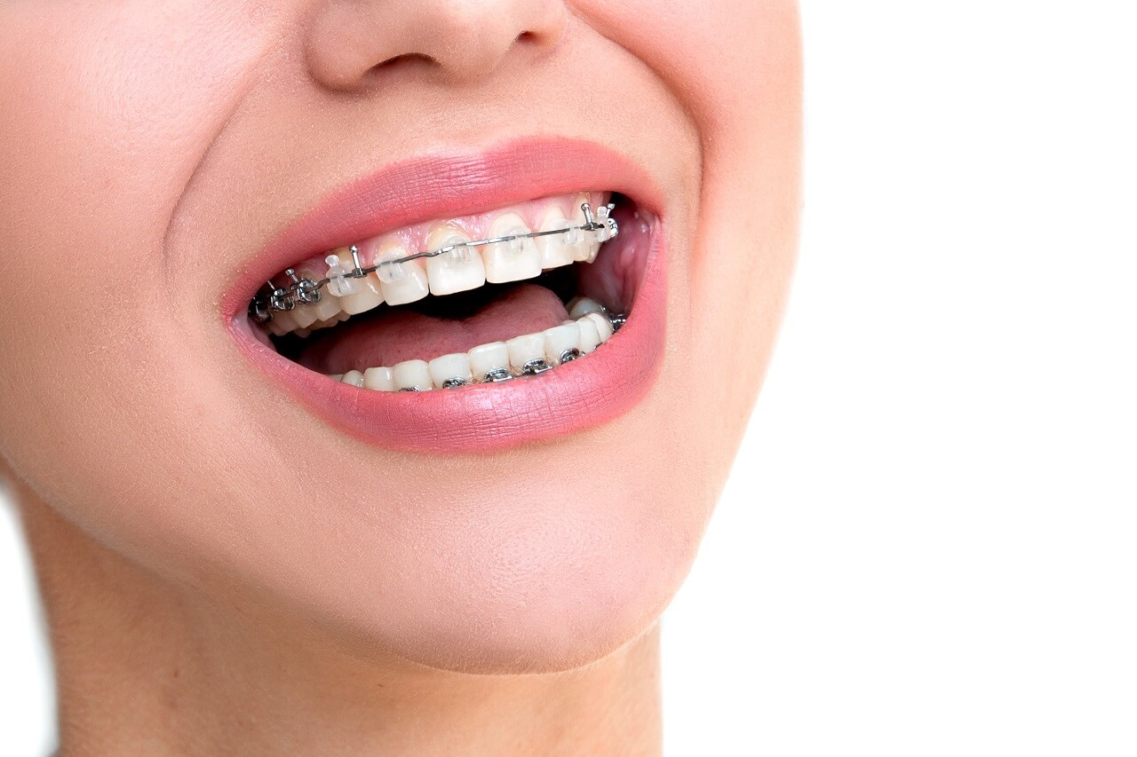 https://vistadental.ca/wp-content/uploads/2021/06/traditional-braces-in-scarborough.jpg