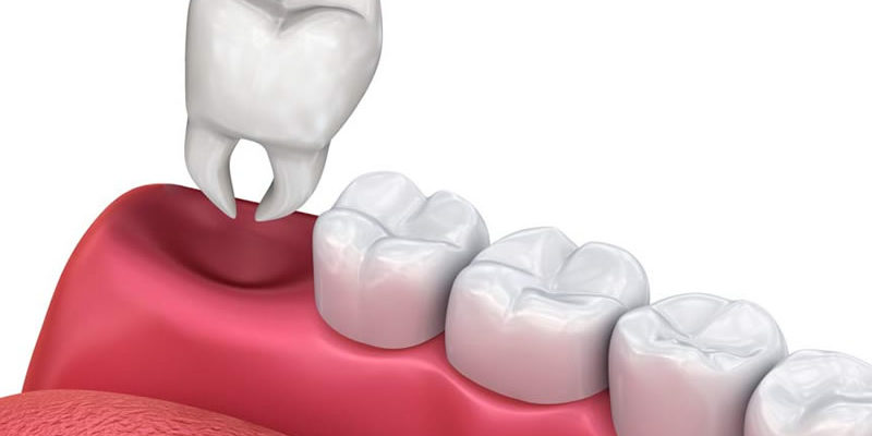 wisdom tooth extraction in scarborough