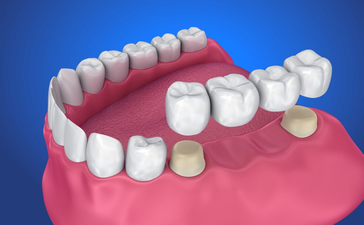 How to Take Care of a Removable Dental Bridge