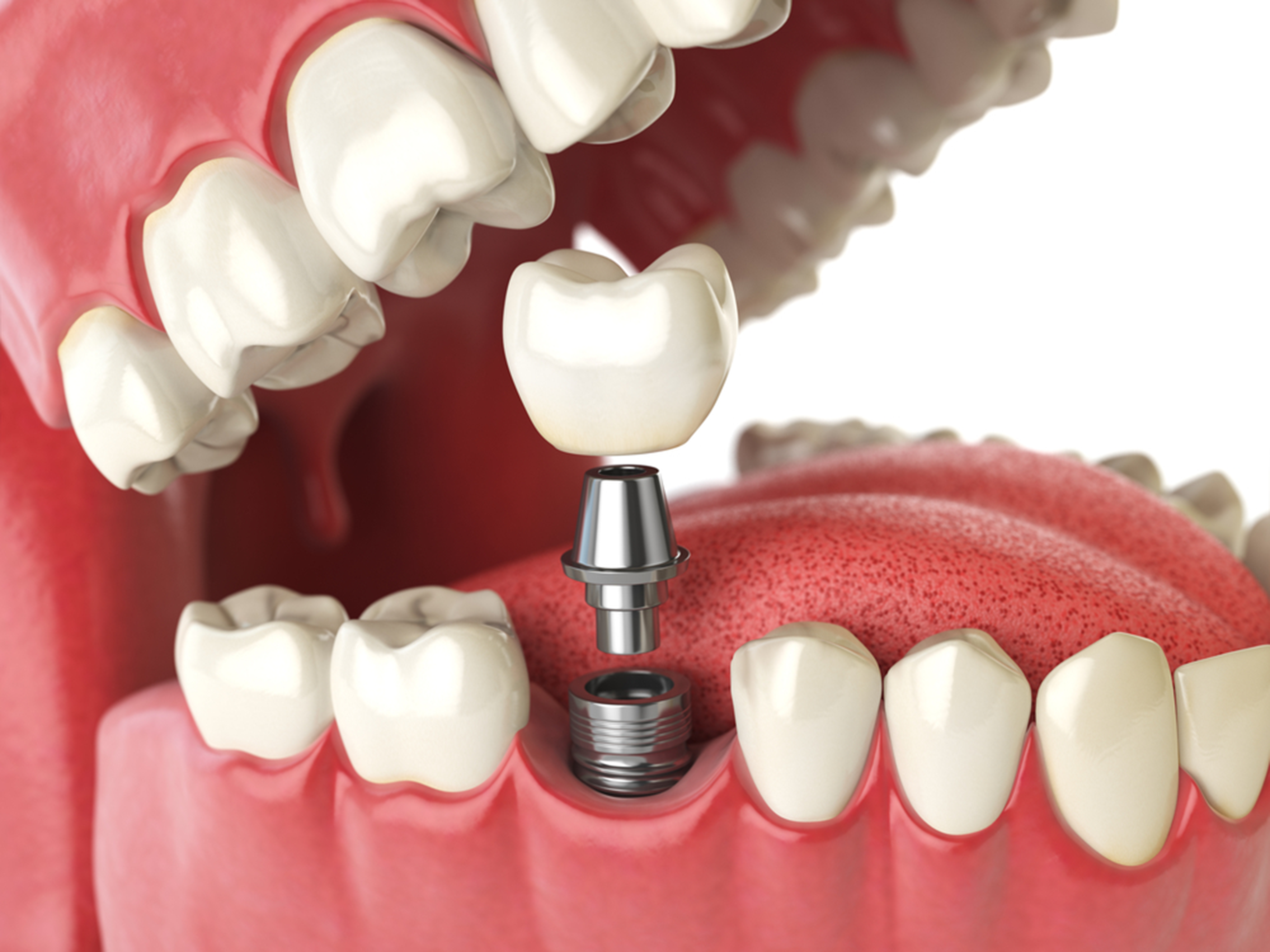Dental Implants in Scarborough