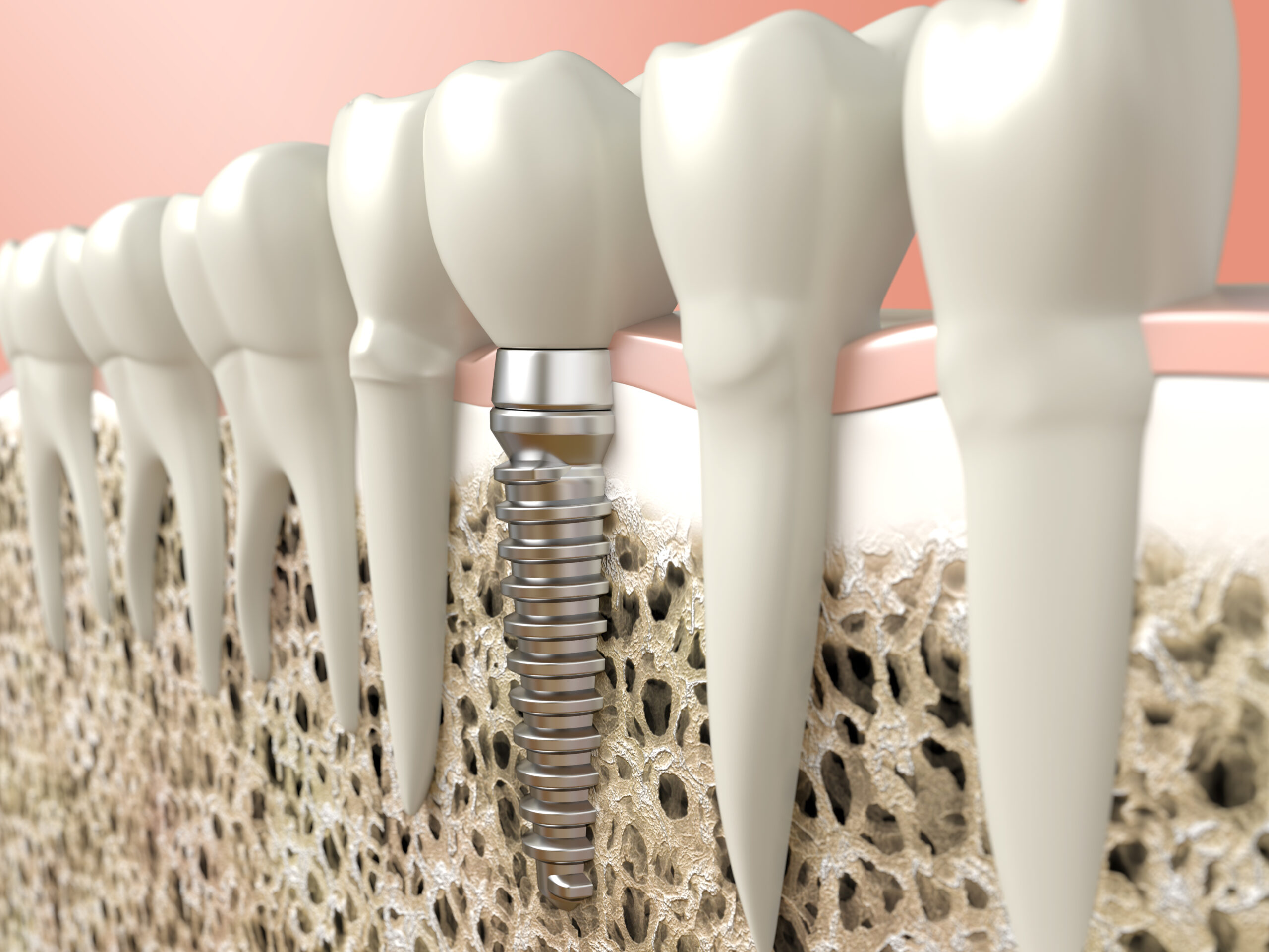 Dental Implants in Scarborough